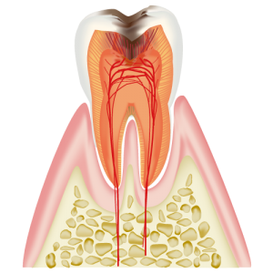 C3　神経 (歯髄)に達した虫歯