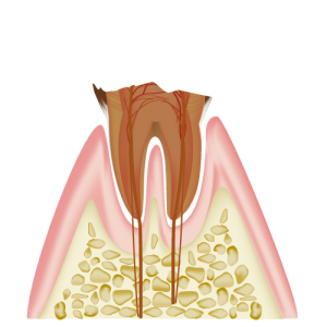 C4　歯質が失われた虫歯