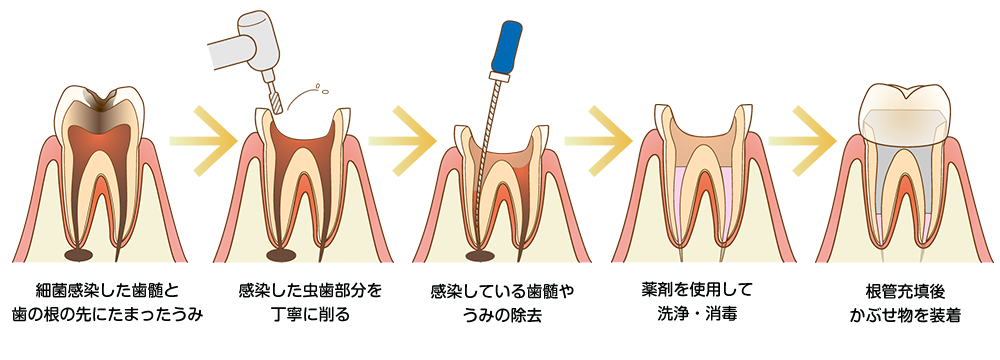 根管治療の流れ