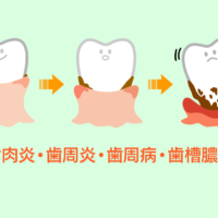 歯肉炎、歯周炎、歯周病、歯槽膿漏