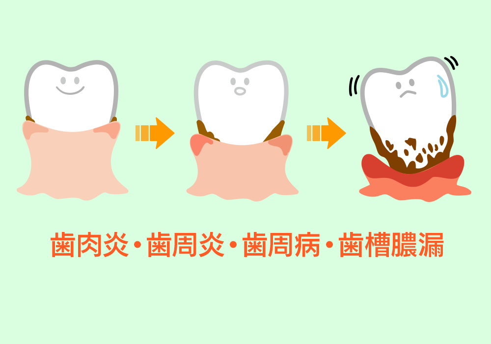 歯肉炎、歯周炎、歯周病、歯槽膿漏