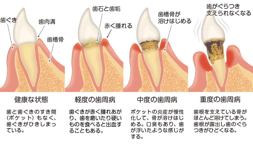 歯周病の進行の流れ