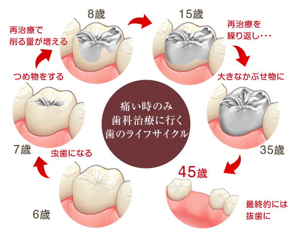 痛い時に歯科治療に行く歯のライフサイクル